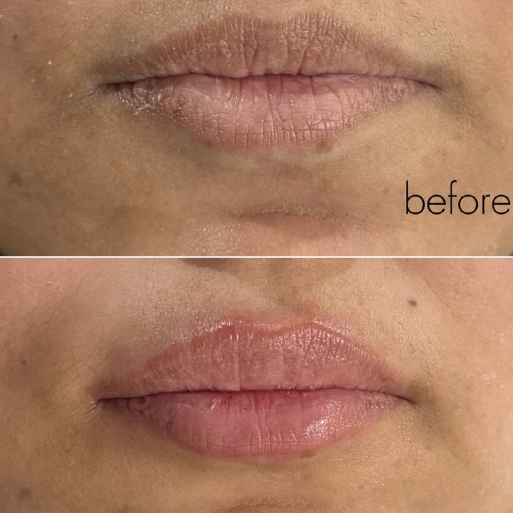 Body Sculpting Treatment