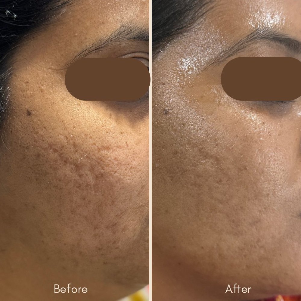 Hair Restoration Treatment