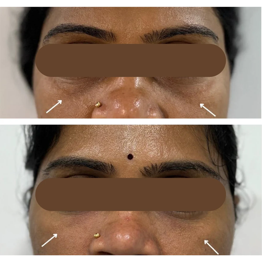 Under Eye Rejuvenation