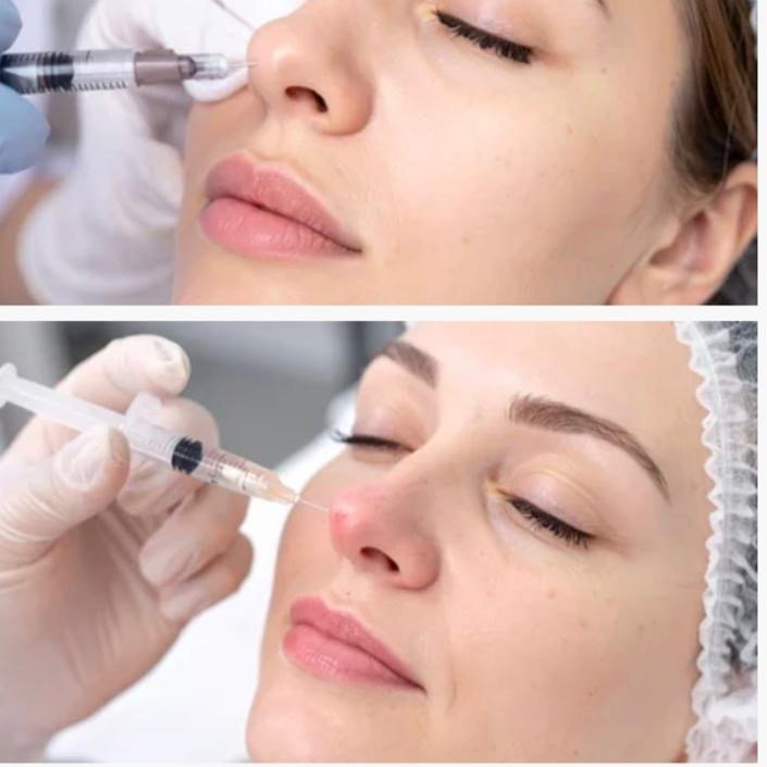 Microneedling